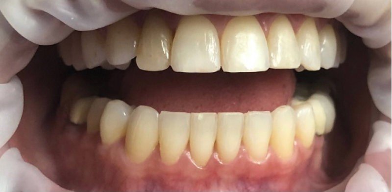 Before whitening treatment at Bhati Dental Clinic